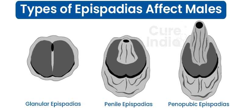 Types of Epispadias